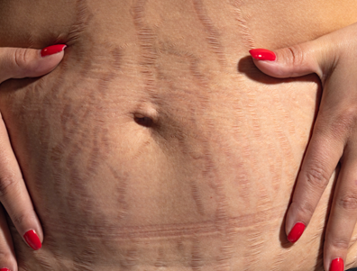 Anti Stretch Marks